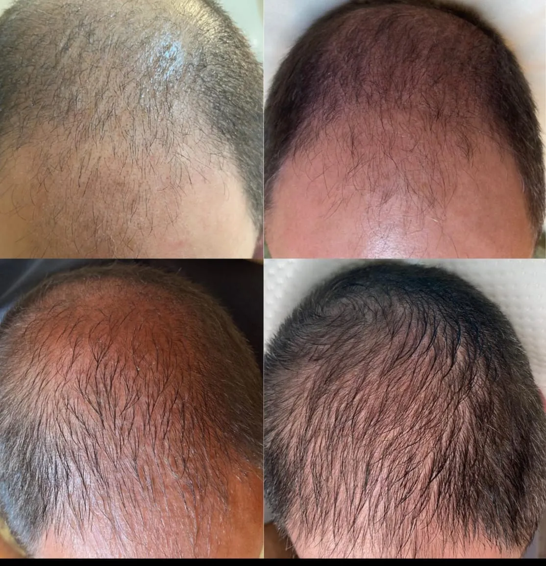 Hair Regrowth (Procell) – photo 1