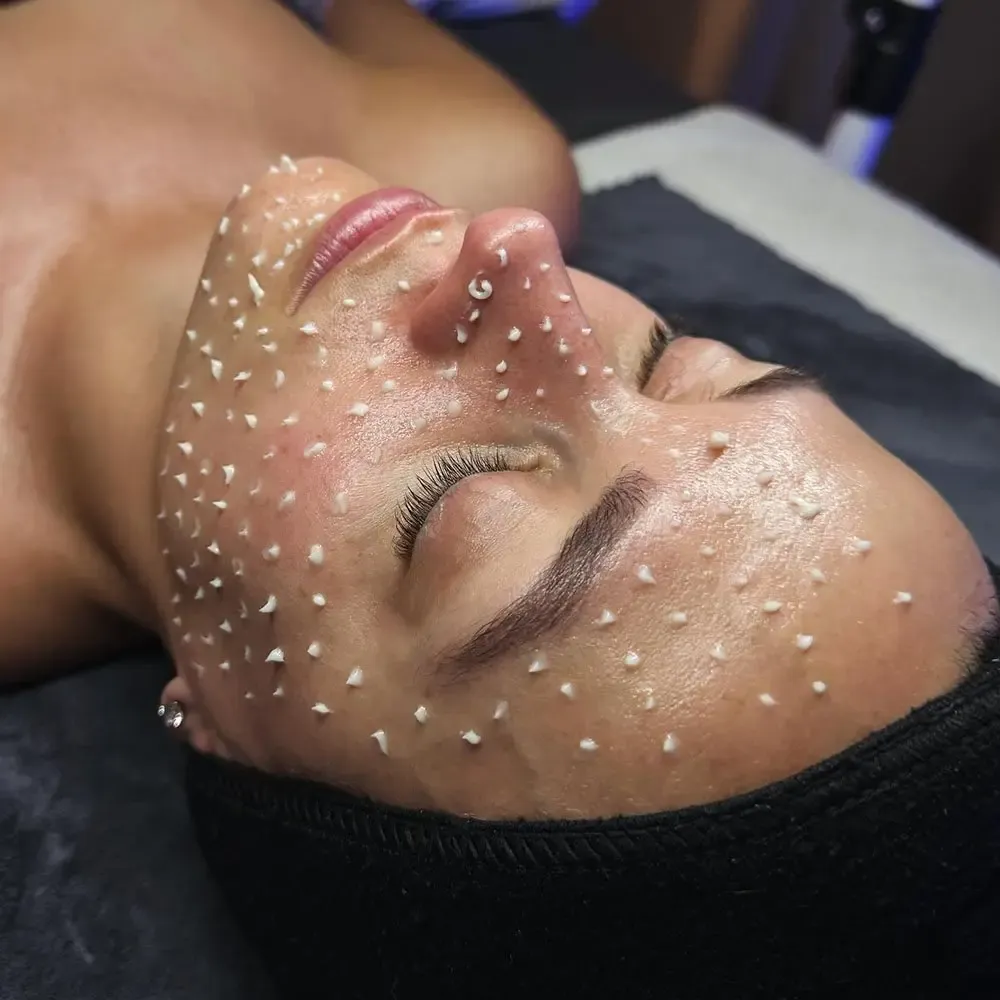 Mesotheraphy/Microneedling – photo 2