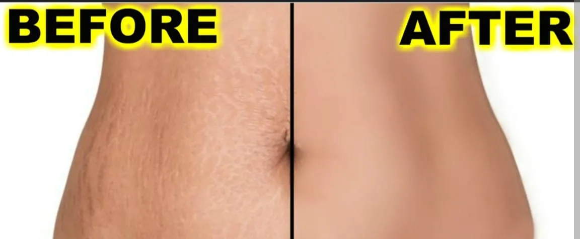 Stretch Mark And Tag Removal – photo 3
