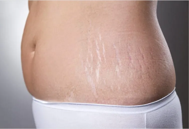 Stretch Mark And Tag Removal – photo 1
